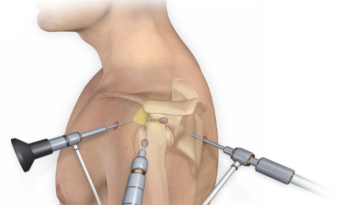 عمل آرتروسکوپی شانه