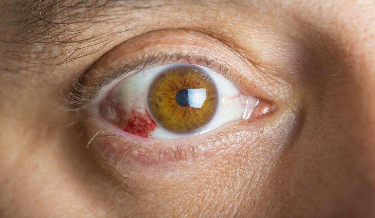 خونریزی در چشم