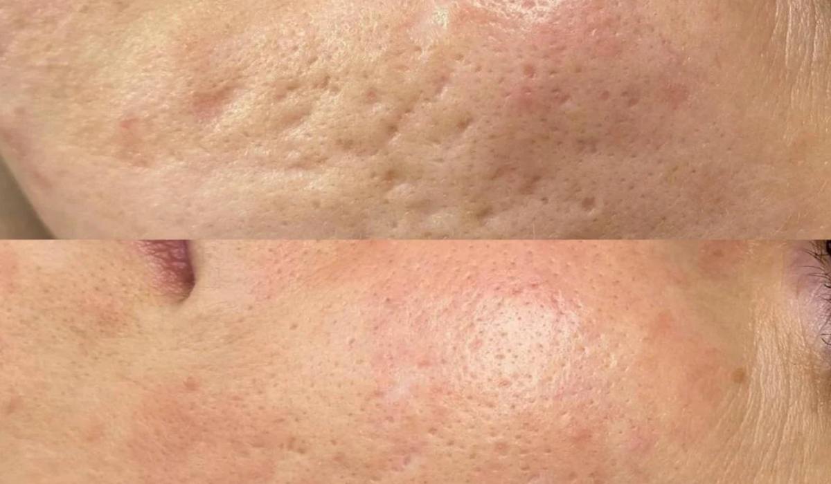 تاثیر آر اف فرکشنال