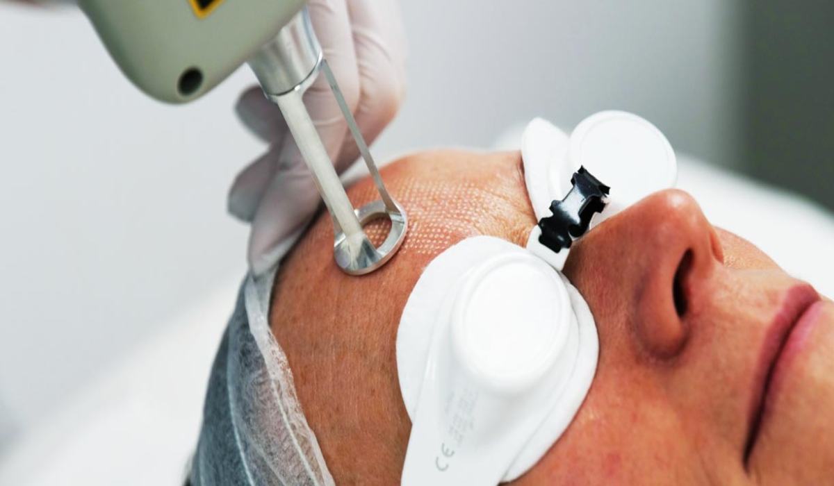 لیزر فرکشنال از روش های ترکیبی لیفت و جوانسازی پوست