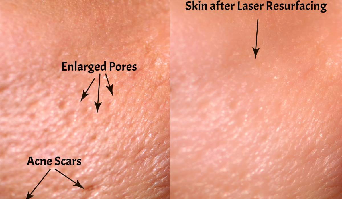 تاثیر لیزر فرکشنال