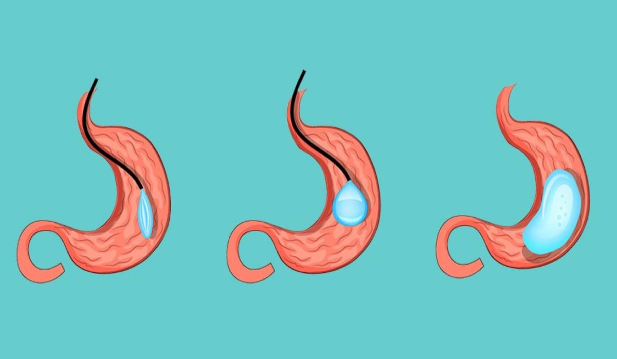 تاثیر تزریق بوتاکس معده