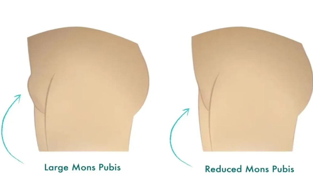 عمل زیبایی واژن مونس‌پلاستی