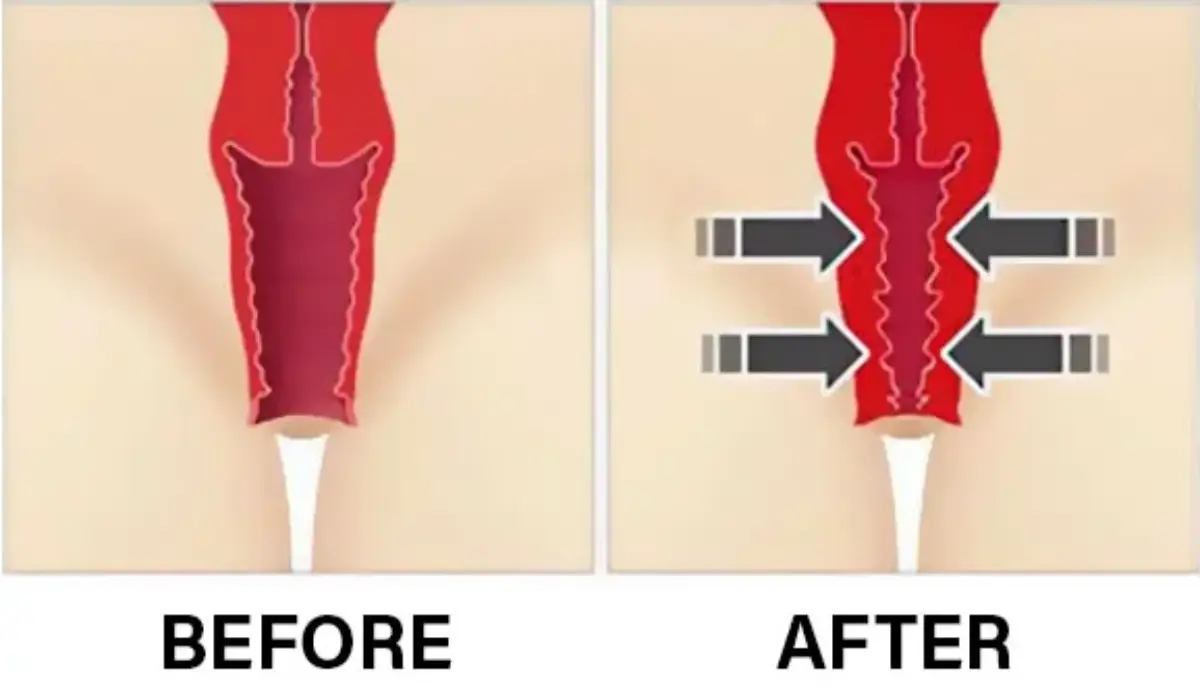 جراحی زیبایی دستگاه تناسلی زنان