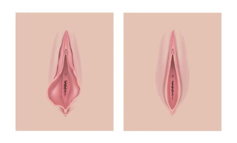 عکس جراحی زیبایی واژن