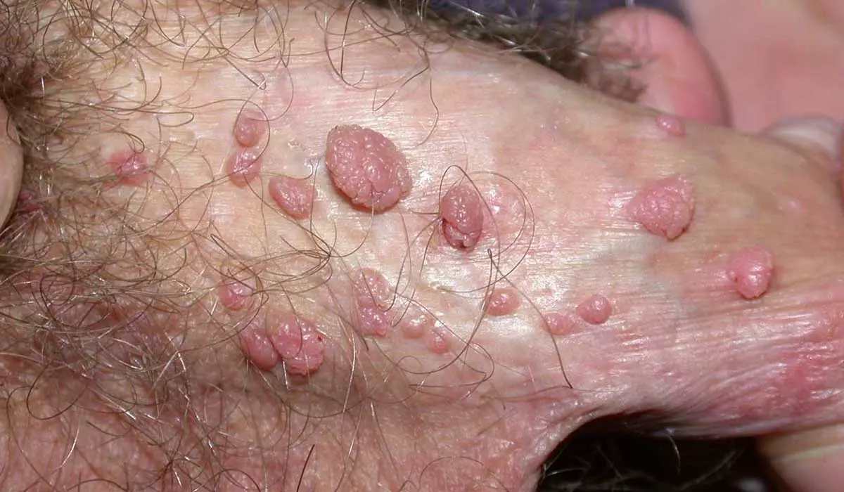 عکس زگیل تناسلی در مردان