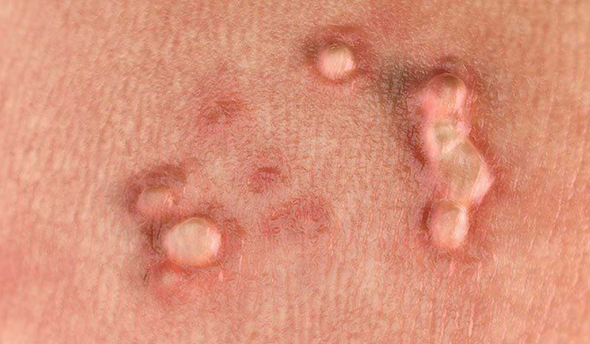 زگیل تناسلی 