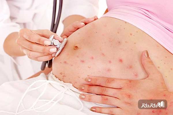 آبله مرغان و راه رهایی از خارش تاول های ناشی از آن_مستطیل زرد 2 ابله مرغان در بارداری