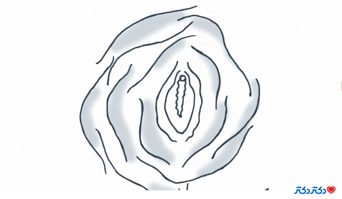 انواع پرده بکارت