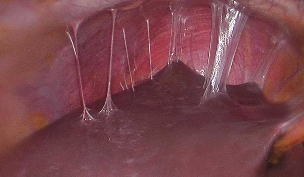 درمان سرفه خلط دار چیست