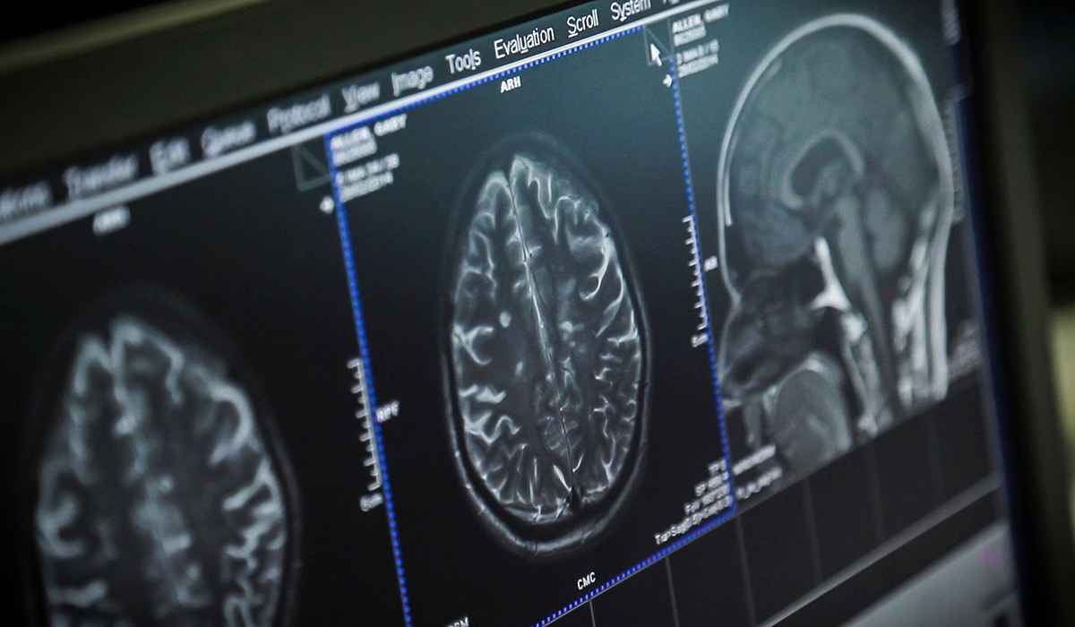 ام آر آی (mri) چیست و برای تشخیص چه بیماریهایی کاربرد دارد؟_مستطیل زرد 16 تصاویر مغز با اسکن ام آر آی