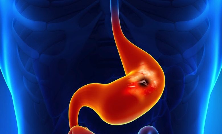 چه دلایلی علتمدفوع سیاه و قیری رنگ می شوند + درمان_مستطیل زرد 1 مدفوع سیاه و قیری رنگ