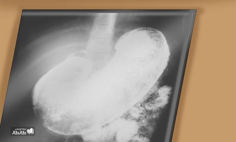 درمان گاستریت