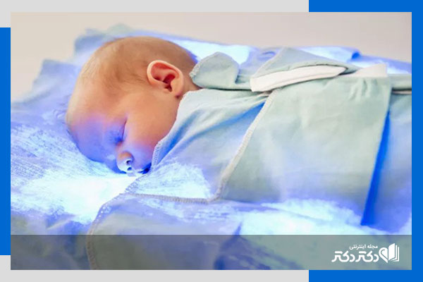علت زردی چشم نوزاد در یک ماهگی	