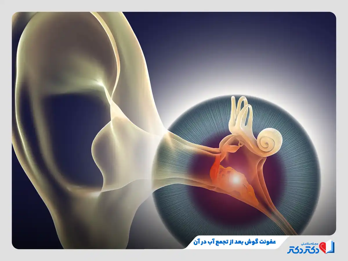 عفونت گوش در اثر تجمع آب در آن و شکل‌گیری بستر رشد میکروب‌ها