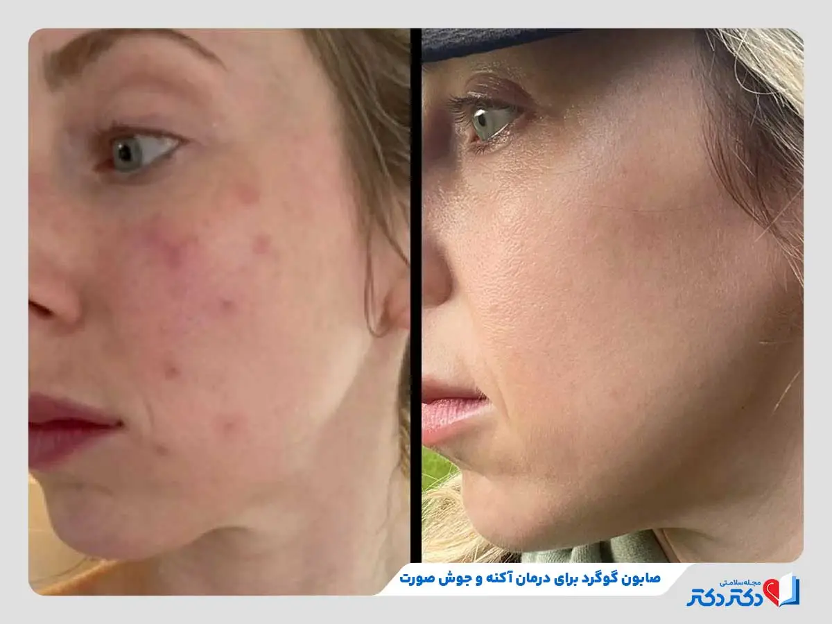 صابون گوگرد چیست و چه خواصی دارد؟ + بایدها و نبایدها_مستطیل زرد 26 قبل و بعد از استفاده از صابون گوگرد برای درمان جوش صورت