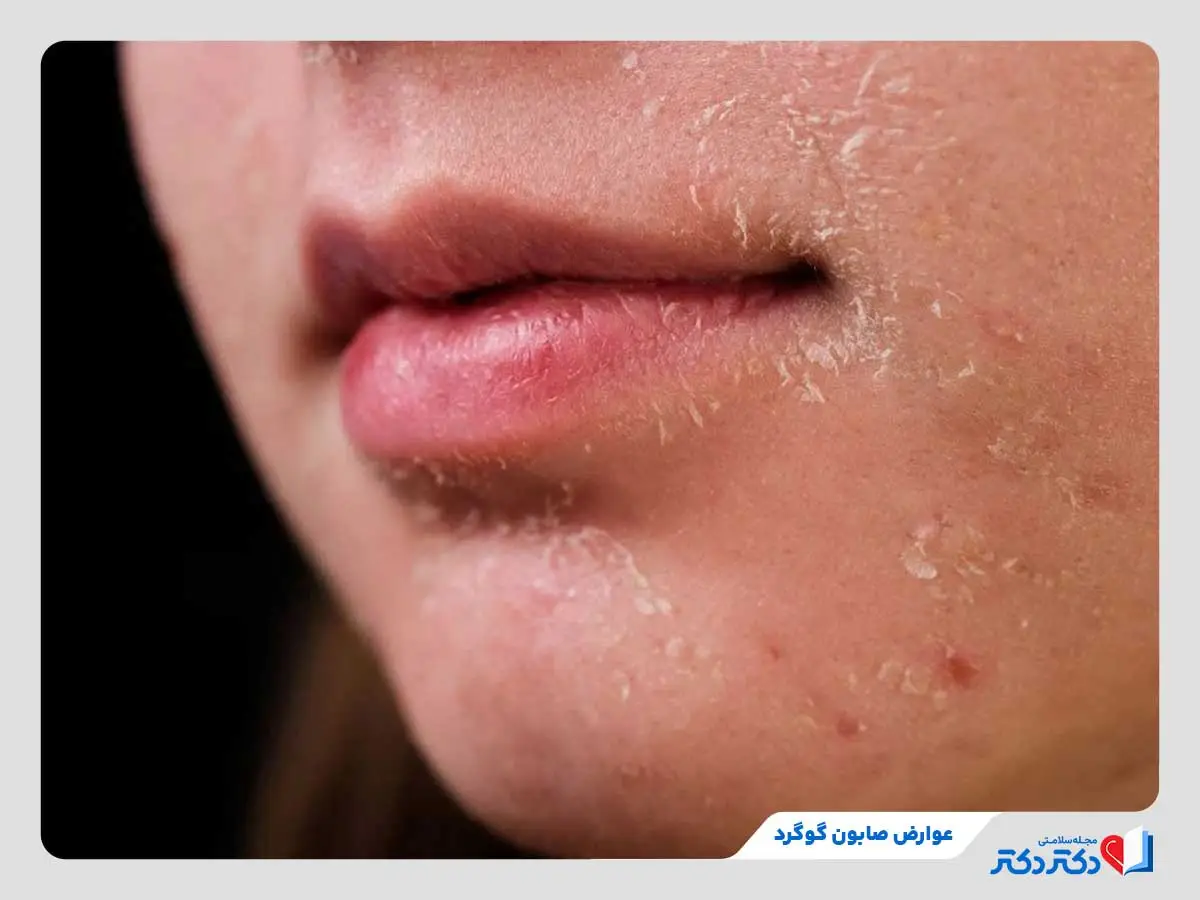 صابون گوگرد چیست و چه خواصی دارد؟ + بایدها و نبایدها_مستطیل زرد 34 خشکی و پوستهپوسته شدن پوست دختر جوان بعد از استفاده از صابون گوگرد