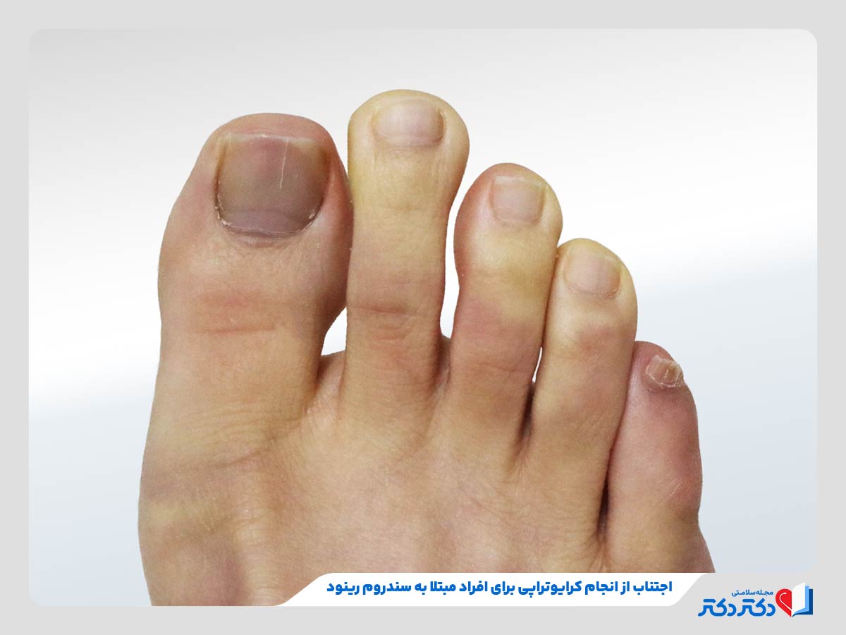 فریز کردن زگیل تناسلی یا کرایوتراپی؛ درمانی سریع و موثر_مستطیل زرد 26 فرد مبتلا به سندروم رینود و موردی نامناسب برای فریز کردن زگیل تناسلی