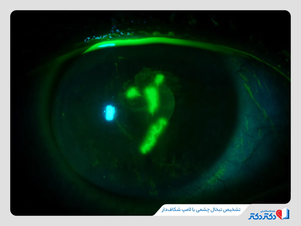 راهنمای کامل تشخیص و درمان تبخال چشمی + معارفه روش درمان آن_مستطیل زرد 10 لامپ شکاف دار یکی از روشهای بالینی برای تشخیص تبخال چشمی
