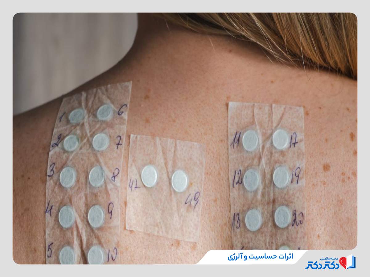 درمان انواع آلرژی همچون خارش و کهیر با فواید داروی لوو ستیریزین