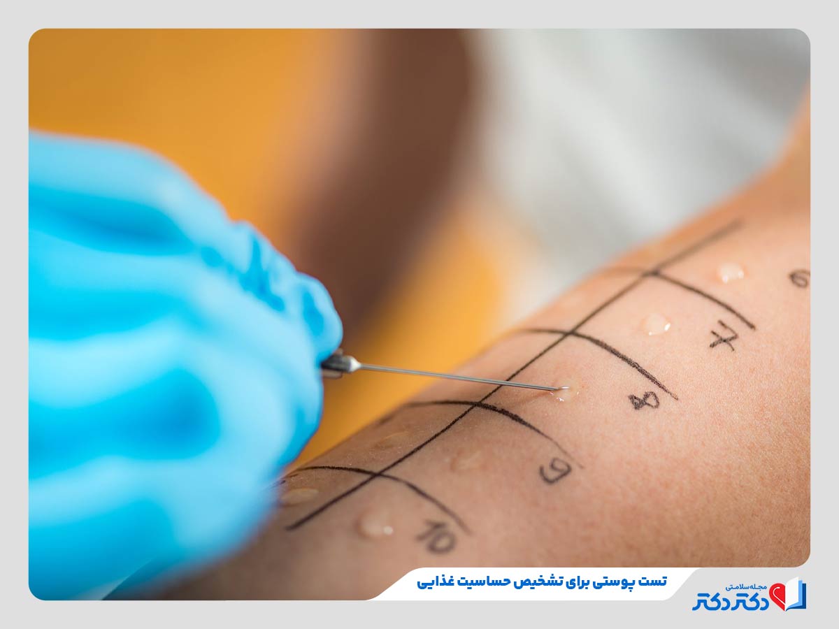 پزشک در حال تست پوستی برای شناسایی علت حساسیت غذایی در فرد