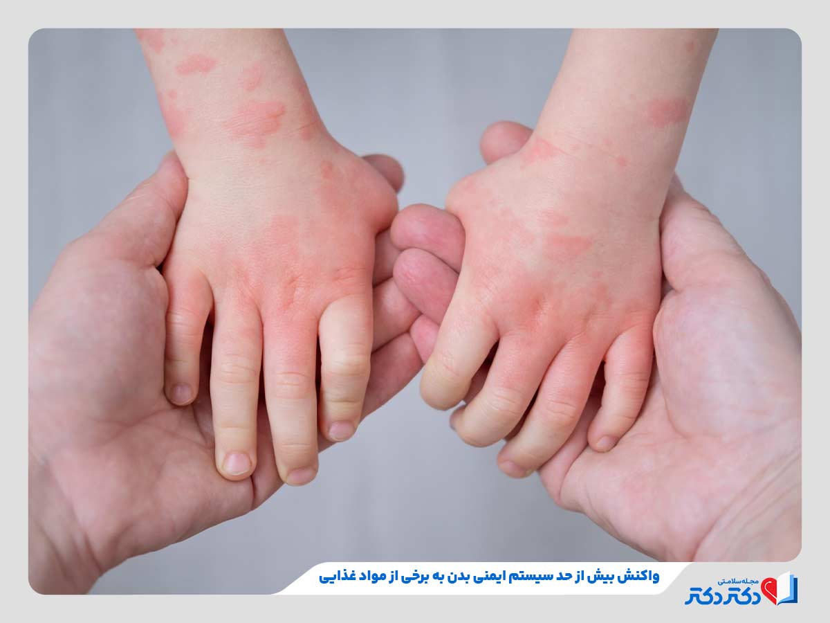کودک مبتلا به خارش و کهیر در اثر ابتلا به آلرژی غذایی