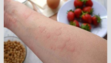 فرد مبتلا به کهیر در اثر ابتلا به حساسیت غذایی