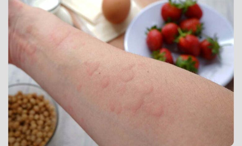 فرد مبتلا به کهیر در اثر ابتلا به حساسیت غذایی