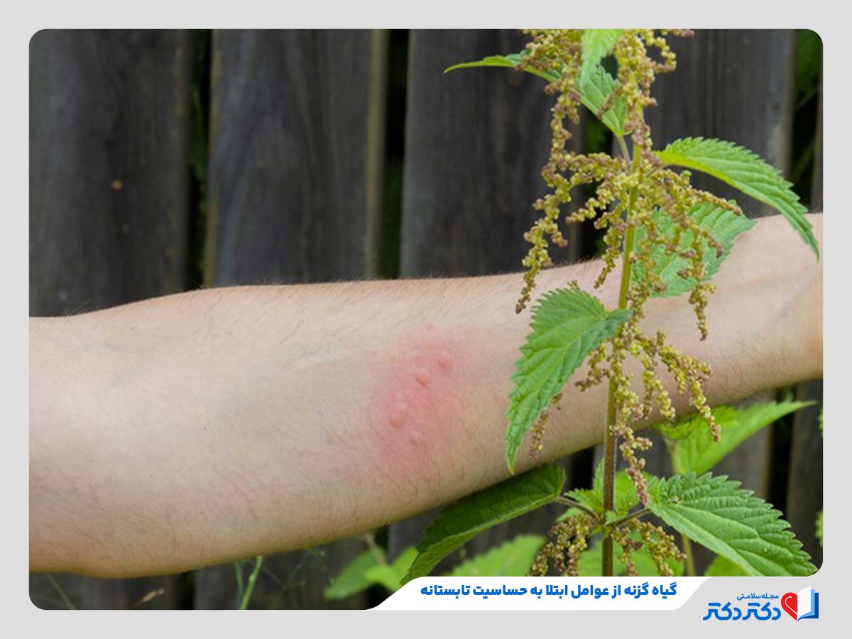 فرد مبتلا به خارش پوستی و خارش گلو به دلیل حساسیت تابستانی در اثر گیاه گزنه