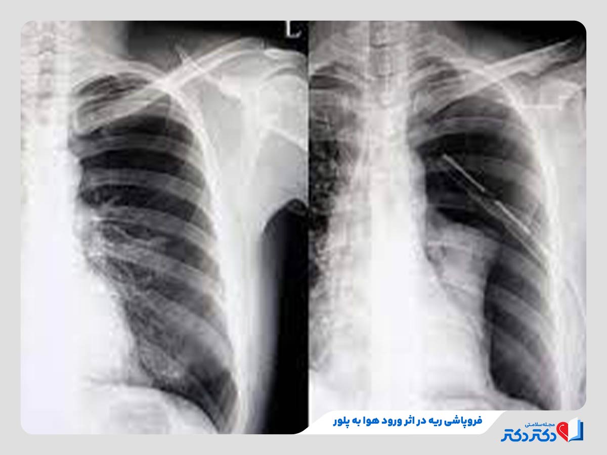 معارفه همه بیماری های ریه + راه حلهای پشگیری و درمان انواع آن_مستطیل زرد 20 ریه فرد مبتلا به پنوموتوراکس یکی از انواع بیماری ریوی