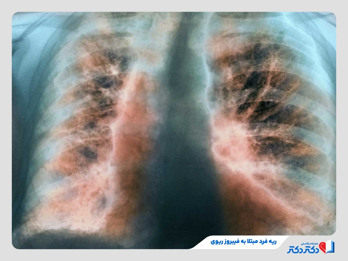 معارفه همه بیماری های ریه + راه حلهای پشگیری و درمان انواع آن_مستطیل زرد 18 فرد مبتلا به فیبروز ریوی یکی از انواع بیماری های ریه
