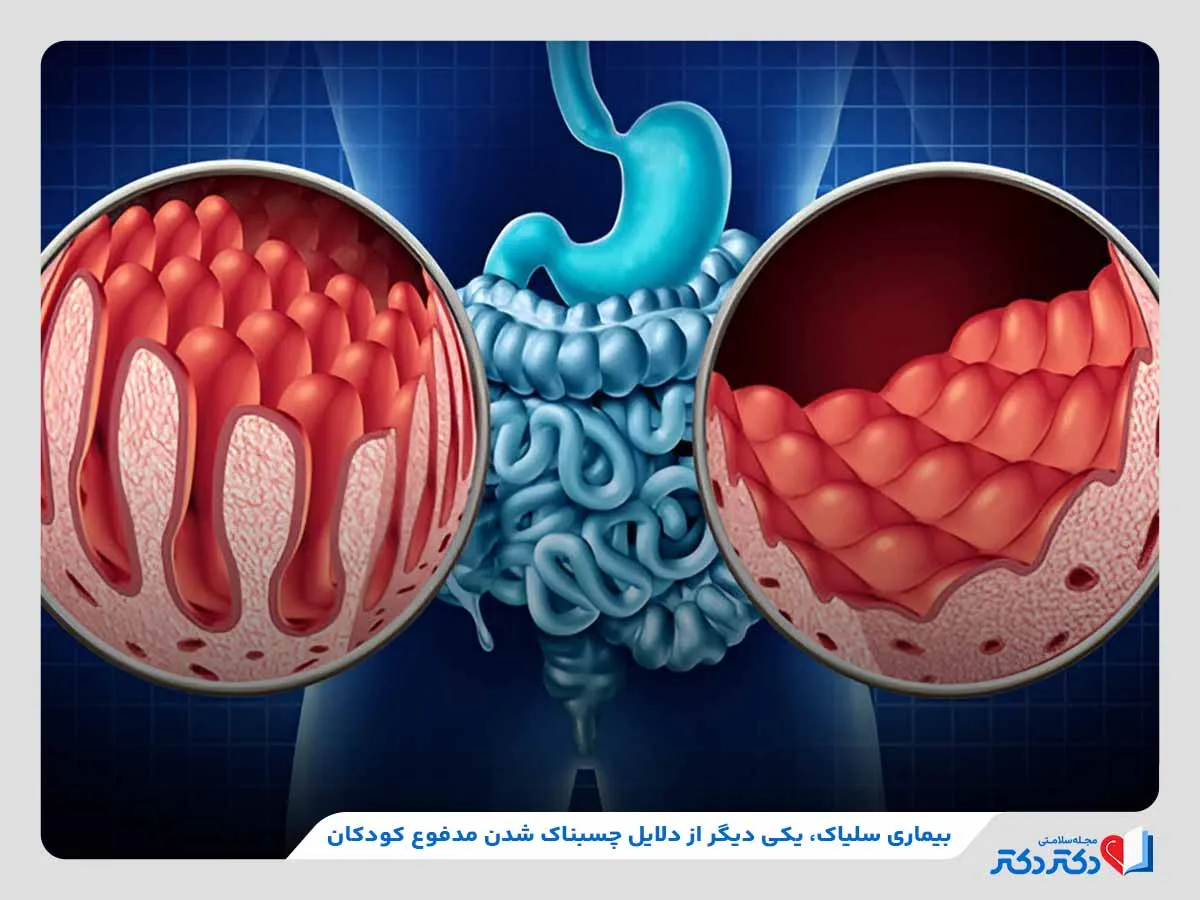 بیماری سلیاک، یکی از بیماری‌های تاثیرگذار در چسبناک شدن مدفوع