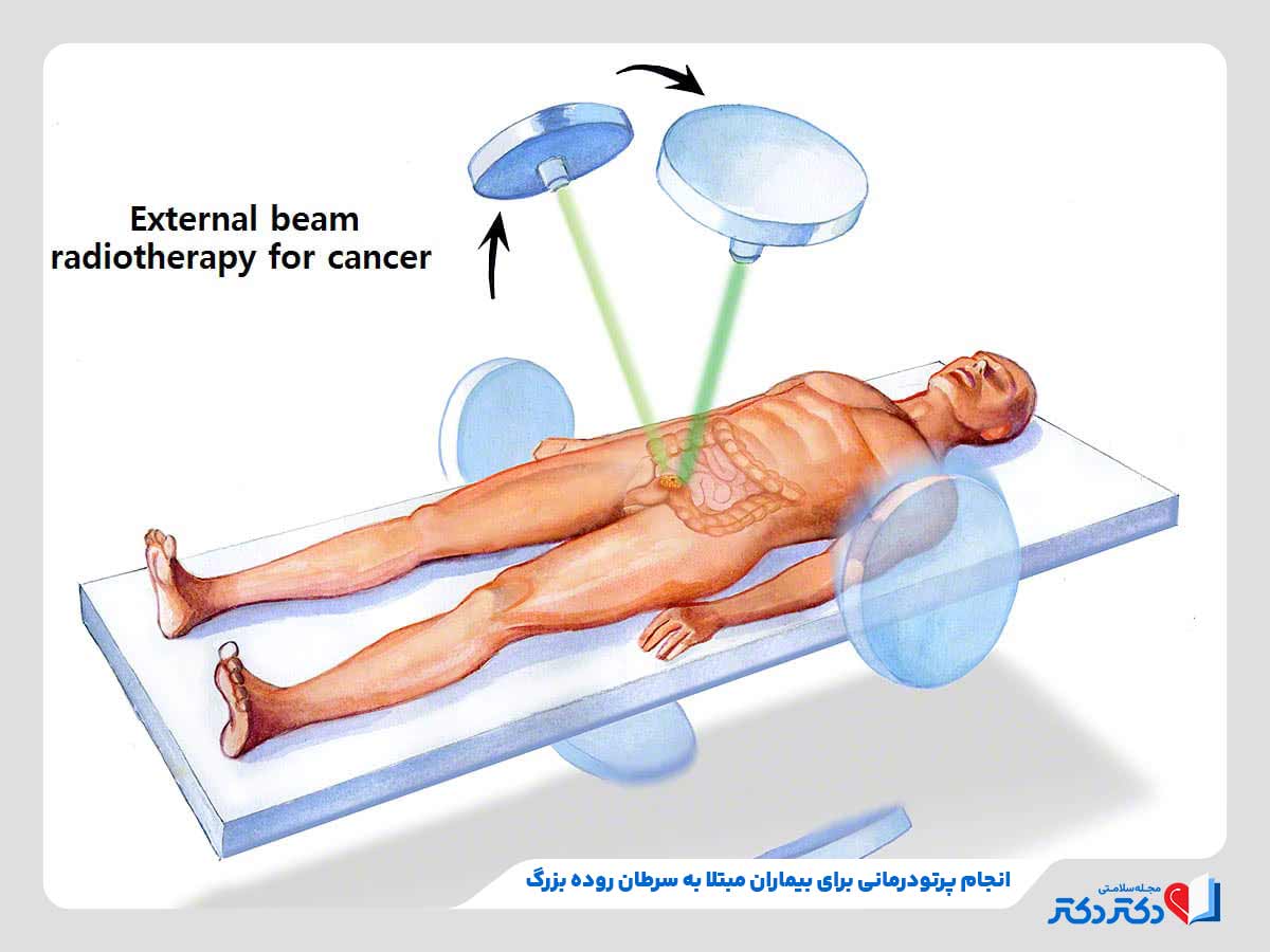 فرد تحت پرتودرمانی برای از بین سلول‌های سرطانی