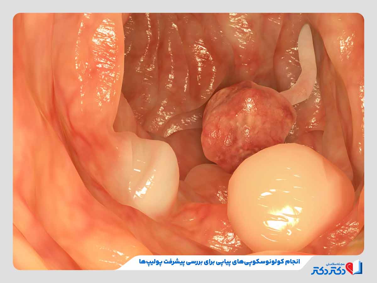 تصویر پیشرفت پولیپ روده فرد تحت کولونوسکوپی‌های پیاپی