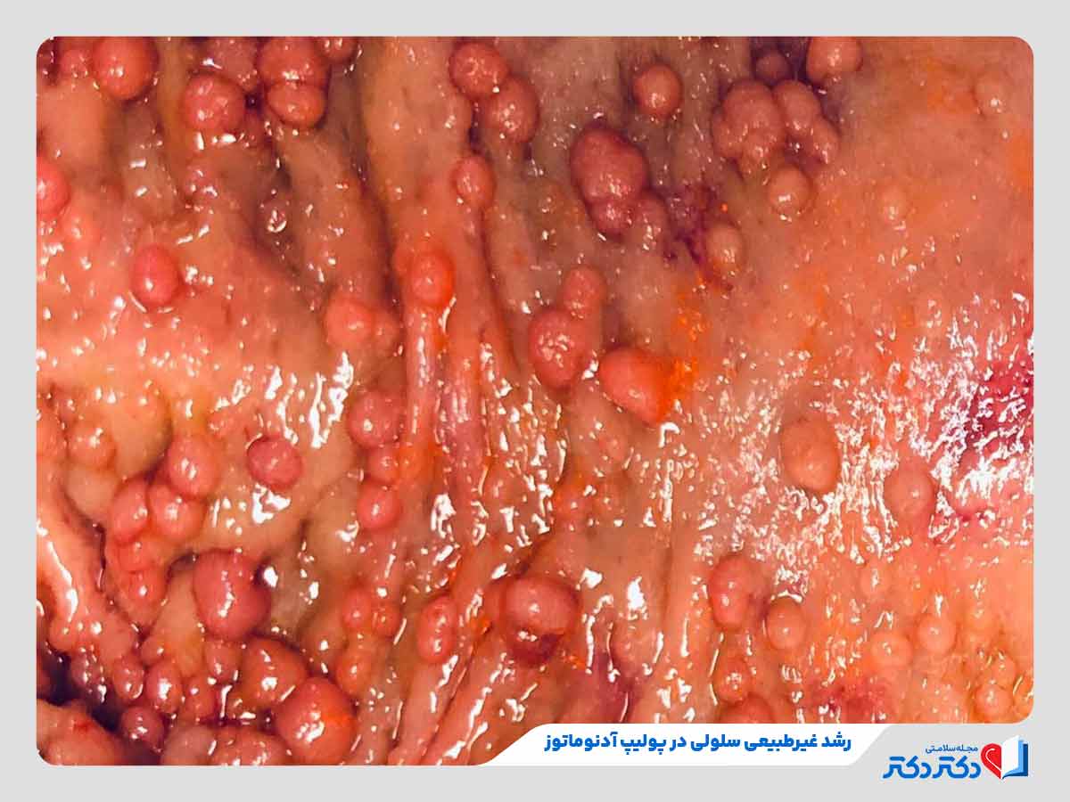 تصویر روده فرد مبتلا به پولیپ روده آدنوماتوز در اثر تقسیم غیرطبیعی سلول‌ها