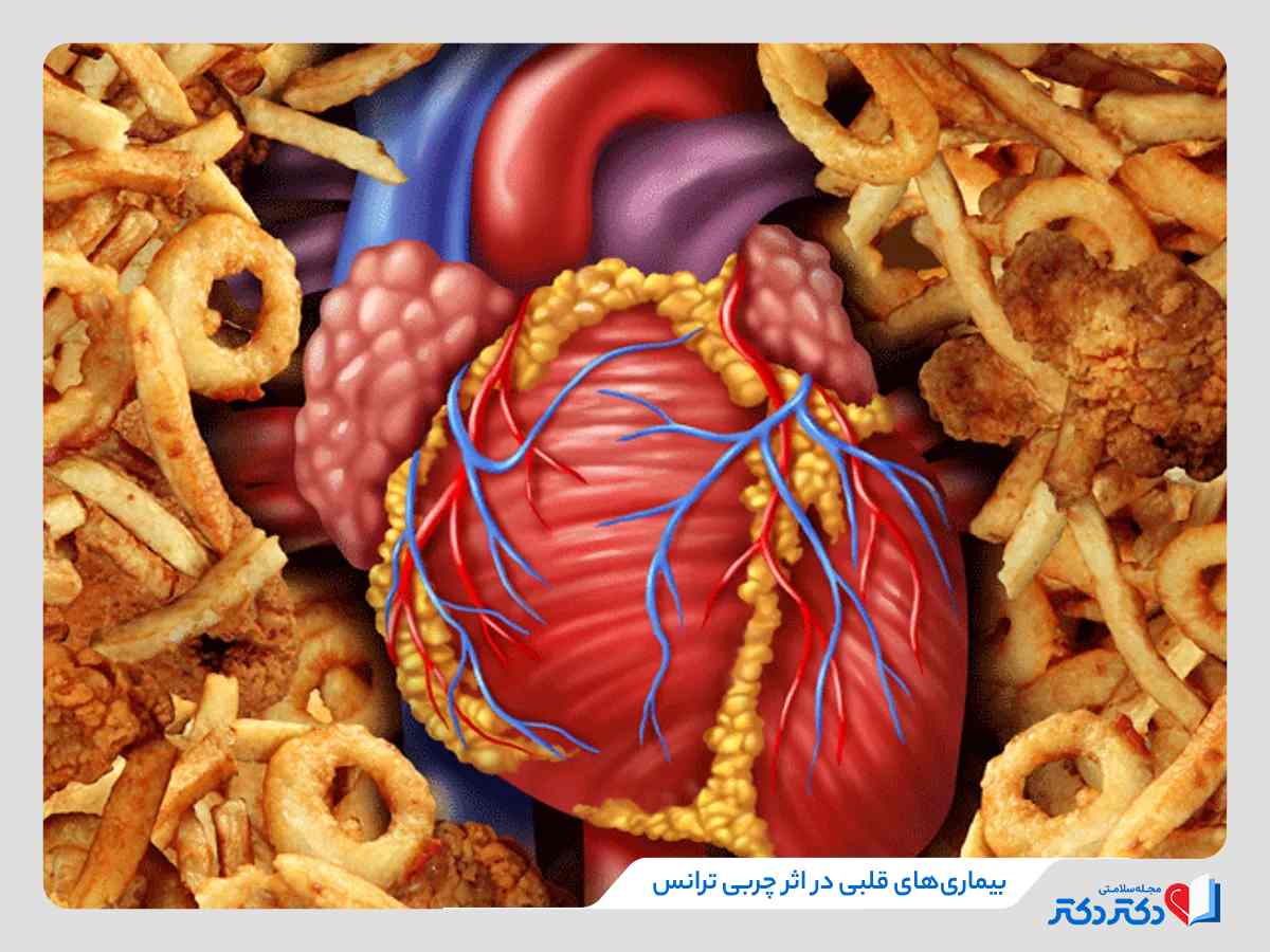 چربی ترانس چیست؟ 11 منبع مهم چربی های ترانس + درمان اصولی_مستطیل زرد 4 مضرات چربی ترانس چیست؟