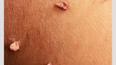 شکل زگیل تناسلی