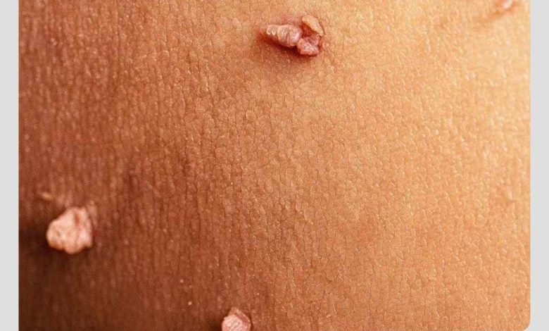 شکل زگیل تناسلی