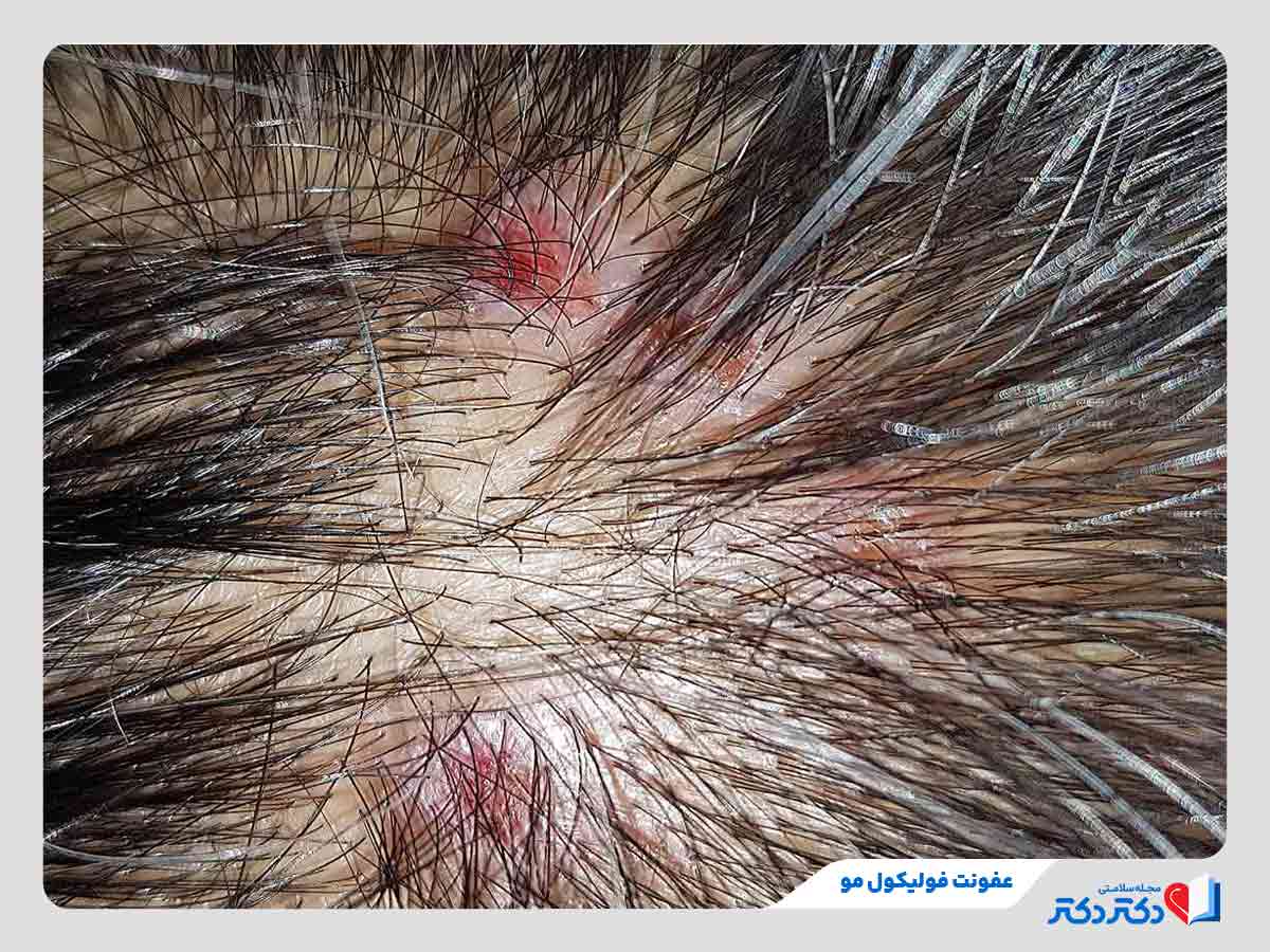 زنی مبتلا به فولیکولیت یا عفونت فولیکول مو