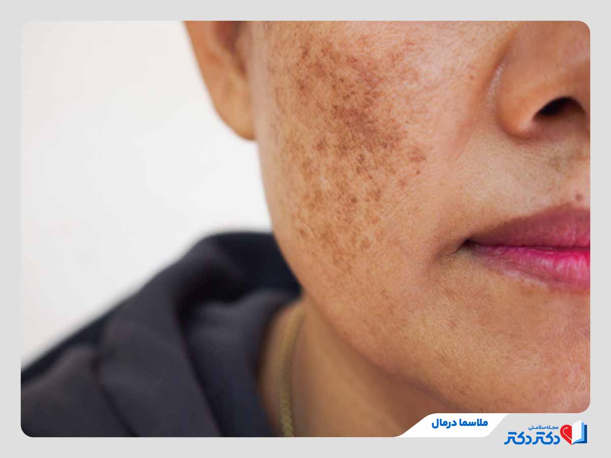 زن مبتلا به لک ملاسما در نواحی عمقی صورت