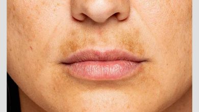 زن مبتلا به لک پلاسما در ناحیه لب و صورت