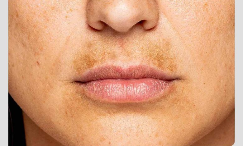 زن مبتلا به لک پلاسما در ناحیه لب و صورت