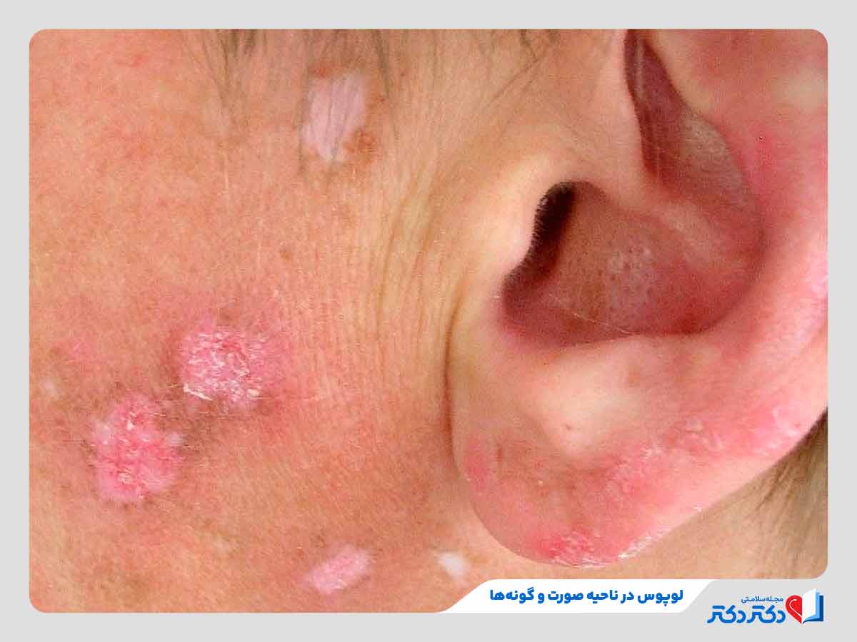 زن مبتلا به لوپوس پوستی در ناحیه صورت