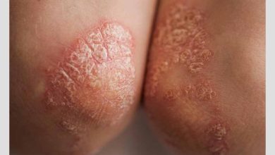 فرد مبتلا به لوپوس پوستی