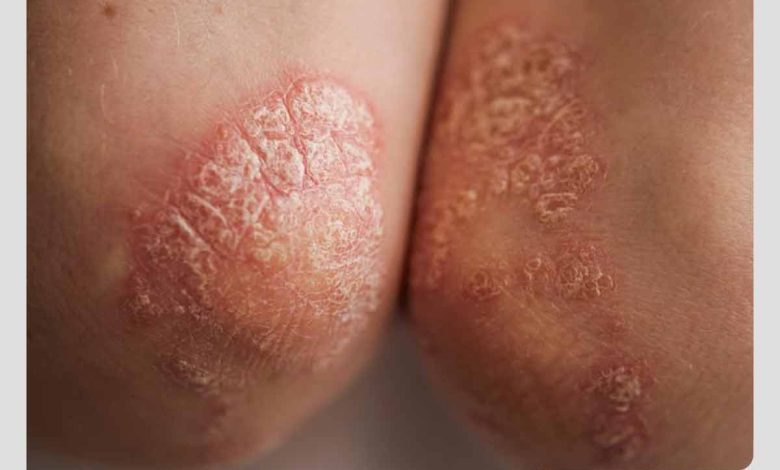 فرد مبتلا به لوپوس پوستی