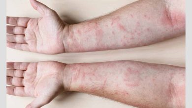 فرد مبتلا به اگزما یا درماتیت تماسی