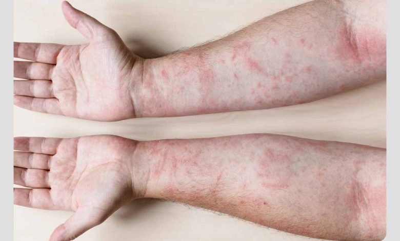 فرد مبتلا به اگزما یا درماتیت تماسی