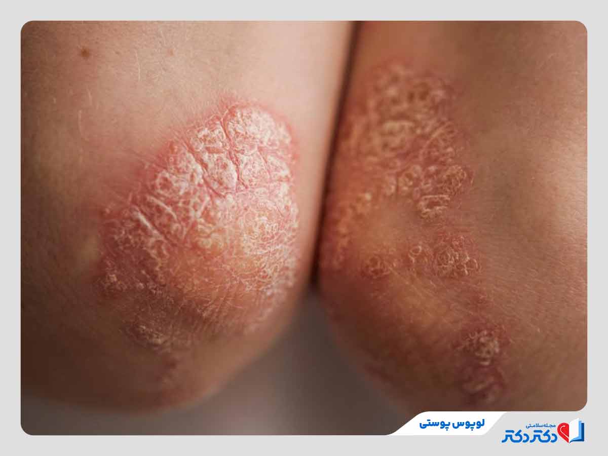 فرد مبتلا به لوپوس پوستی