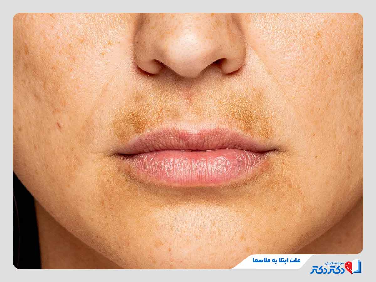 زن مبتلا به لک پلاسما در ناحیه لب و صورت