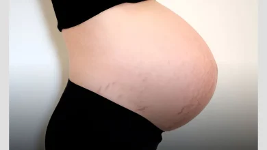 چنین دیررس و سن حاملگی مادر، یکی از عوامل موثر در پوست‌ریزی نوزاد